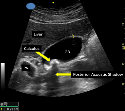 Gallbladder Problems Signs Symptoms and When to Seek Care