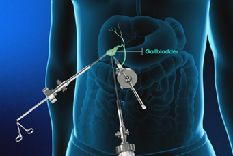 Gallbladder Problems Signs Symptoms and When to Seek Care